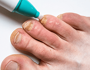 Ingrown Toenail Treatment in Hamilton