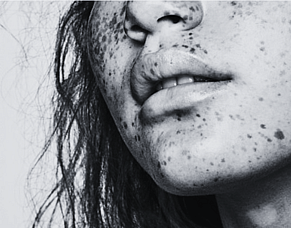 Pigmentation: What&rsquo;s Really Happening Under Your Skin