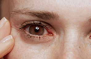 Eye Infections