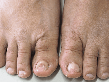 Nail Infections