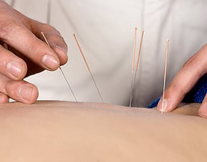 What is Acupuncture? How can Acupuncture help me?