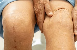 Scars