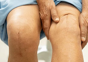 Scars