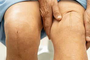 Scars