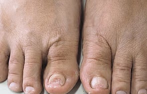 Nail Infections