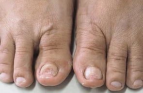Nail Infections