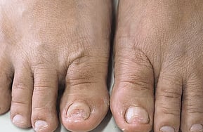 Nail Infections