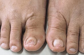 Nail Infections