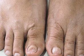 Nail Infections