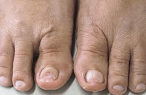 Nail Infections