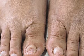 Nail Infections