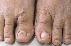 Nail Infections