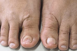 Nail Infections