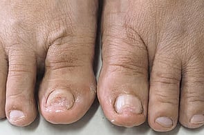 Nail Infections