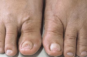 Nail Infections