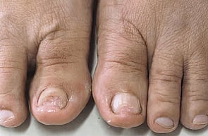 Nail Infections