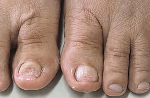 Nail Infections