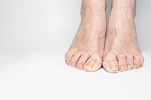 Nail Infections