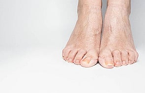 Nail Infections