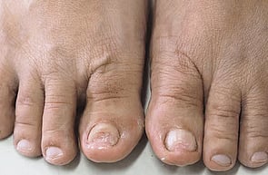 Nail Infections