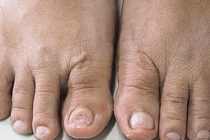 Nail Infections