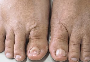 Nail Infections