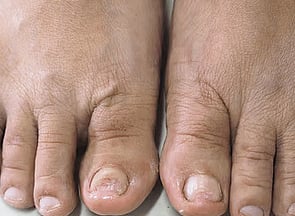 Nail Infections