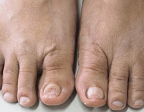 Nail Infections