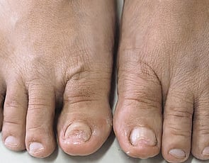 Nail Infections