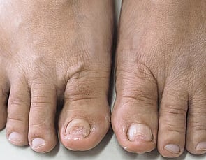 Nail Infections