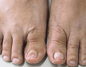 Nail Infections
