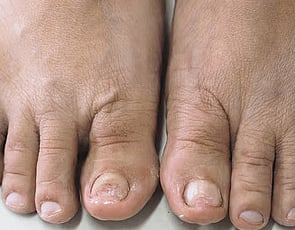 Nail Infections