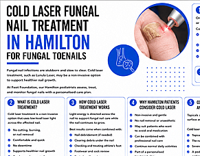 Cold Laser Fungal Nail Treatment in Hamilton