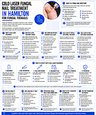 Cold Laser Fungal Nail Treatment in Hamilton