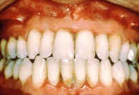 What is gum disease (periodontal disease)?