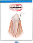 Stages of gum disease