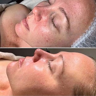 Observ Skin Analysis – Body Beautiful Retreat – Brisbane
