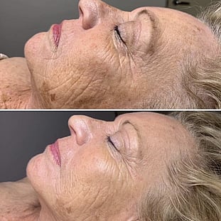 Observ Skin Analysis – Body Beautiful Retreat – Brisbane