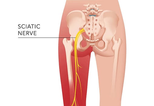 What is Sciatica and how can osteopathy alleviate it?