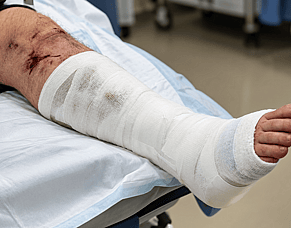 HBOT for Severe Traumatic Limb Injuries:  What Does the 2026 Evidence Tell Us?