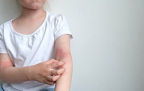 Funded Children's Mild Dermatitis Treatment