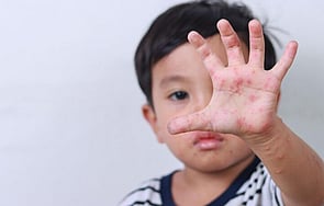 Funded Children’s Skin Infection Treatment