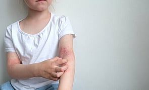 Funded Children&rsquo;s Mild Dermatitis Treatment