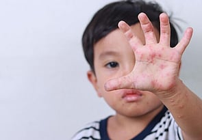 Funded Children&rsquo;s Skin Infection Treatment