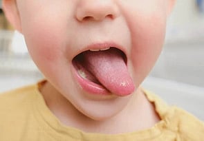 Funded Children&rsquo;s Oral Thrush Treatment