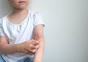 Funded Children&rsquo;s Mild Dermatitis Treatment