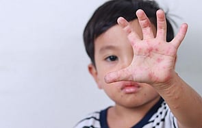 Funded Children&rsquo;s Skin Infection Treatment
