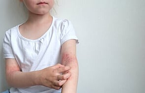 Funded Children&rsquo;s Mild Dermatitis Treatment