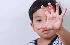 Funded Children&rsquo;s Skin Infection Treatment