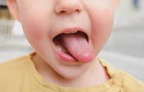Funded Children&rsquo;s Oral Thrush Treatment